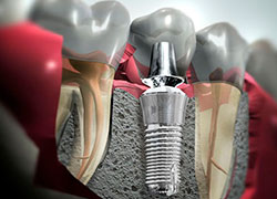 cursos estetica dental en quito Implantes Dentales Ecuador